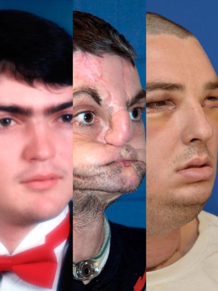 Richard Norris Received A New Face Jaw Teeth And Tongue In The Most Extensive Face Transplant