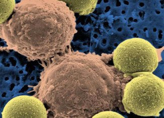 "Microscopic image showing two T cells binding to beads, depicted in yellow, that cause the cells to divide. After the beads are removed, the T cells are infused into cancer patients." (Dr. Carl June / Pennsylvania Medicine)
