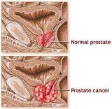 Researchers from Lund University have identified a method that may attack and destroy prostate cancer stem cells