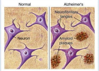 Uncontrolled type 2 diabetes could lead to amyloid plaques in the brain and Alzheimer's disease.