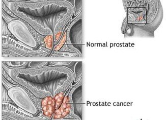 The study shows that prostate cancer death rate was 30 per cent lower in the group taking radium-223 and patients survived for 14 months on average compared with the other group which survived 11 months on average