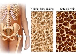 Osteoporosis occurs when bone mineral density is lower. The bones are fragile and break (fracture) easily.