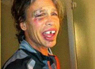 Steven Tyler revealed on The Today Show an image of himself taken shortly after the fall in which he sported broken teeth and a nasty black eye