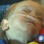 Emmett Rauch, a 2-year-old toddler had 18 surgeries after he swallowed a lithium battery