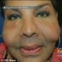 Rajee Narinesingh, a victim of “butt implant doctor” Oneal Ron Morris, reveals the horrific state of her face