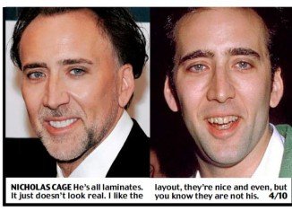 Harry Shiers evaluation on Nicholas Cage teeth changes