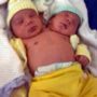 Baby born healthy with two heads in Brazil