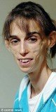 Kate Chilver, 31, weighed 30 kg (66 lb) and was so thin that parts of her stomach and bowel had “died” through lack of blood supply