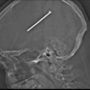 Chicago: man shot a 3.25in nail into his brain without noticing