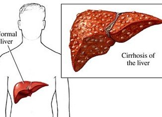 Chronic hepatitis C might lead to liver cirrhosis.