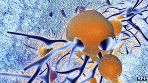 Alzheimer’s plaques (in brown) form around brain cells (in blue) and shrink parts of the brain