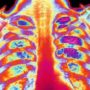 Steam procedure cleans up the lungs in emphysema patients