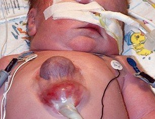 Ryan Marquiss is the first child in the world to survive being born with his heart outside of his body