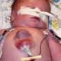 Ryan Marquiss, the world’s first child to survive being born with heart outside his body