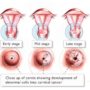 Smear test diagnosis increases cure chances for cervical cancer patients