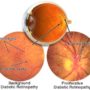 Damage to the retina linked to cognitive decline