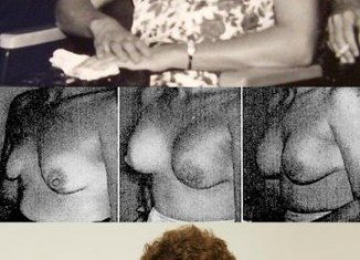 Timmie Jean Lindsey is the first woman who had a breast augmentation with silicone implants in 1962 at Jefferson Davis hospital in Houston