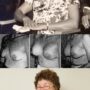 History of breast augmentation