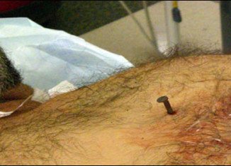 The 4-inch nail pierced the right side of Dennis Hennis’ heart and he went into cardiac arrest
