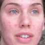 Cassandra Bankson shared her acne ordeal on YouTube and had millions of viewers