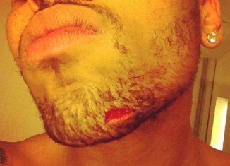 Chris Brown posted a picture of a gash on his chin, apparently sustained from the fight with Drake