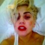 Lady Gaga reveals her black eye after being injured on Auckland stage
