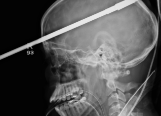 Yasser Lopez, a teenager from Florida, has miraculously survived after a spear was shot through his brain, doctors say