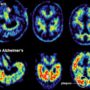 Alzheimer’s early signs appear 25 years before first symptoms