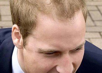 A leading hair transplant surgeon is adamant that Prince William will be completely bald on the top of his head by the time he is 40