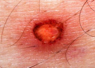 A "spray-on skin" developed by Healthpoint Biotherapeutics, which coats a wound with a layer of skin cells, could help healing leg ulcers
