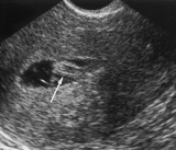 A team of doctors claim that "super-fertility" may explain why some women have multiple miscarriages