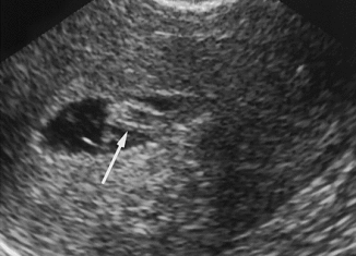 A team of doctors claim that "super-fertility" may explain why some women have multiple miscarriages