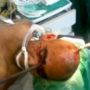 Eduardo Leite survives after six-foot steel rod pierced his head