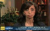 Lizzie Velasquez was born without adipose tissue, meaning she has no body fat and, despite eating up to 60 small meals a day, remains at a delicate 58 lbs