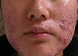 Scientists have discovered that a harmless virus that lives on our skin could be used as a treatment for acne