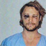 Gabriel Aubry displays painful-looking and swollen black eye, along with cuts under his left eye and on his forehead and the bridge of his nose following brawl with Olivier Martinez