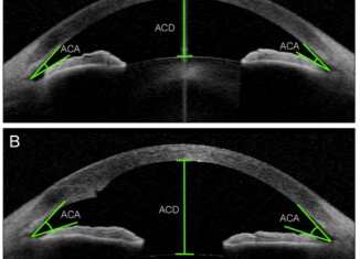 Optical Coherence Tomography test may offer a fast and easy way to monitor patients with multiple sclerosis