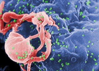An immediate treatment after HIV infection may be enough to functionally cure about a 10th of those diagnosed early