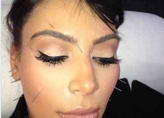 Kim Kardashian appears to be carrying on painful extremes trend, this time with acupuncture