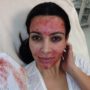 Kim Kardashian gets a vampire blood facial