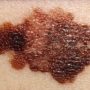 Melanoma is able to fend off the body’s immune system