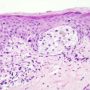 Why is melanoma resistant to treatment? Findings suggest possible strategy for improvement