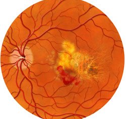 Macular degeneration is more common in old age