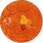 Macular degeneration prevented by cholesterol drugs