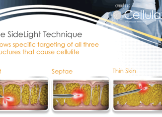 Cellulaze is the first scientifically validated laser cellulite treatment approved by FDA