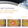 Cellulaze: First scientifically validated laser cellulite treatment approved by FDA