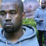 Kanye West has a bump on his forehead after hitting his head on a caution sign