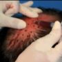 Best baldness treatment: Hair regrow stimulated by platelet-rich plasma (PRP) injection