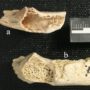 Cancer evidence in Neanderthal fossil