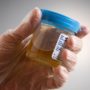 Bladder cancer detected in urine odors